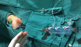 造影视频全过程,揭示血管奥秘与诊疗过程