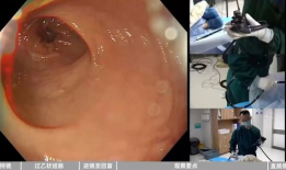 肠镜怎么做的过程视频,直观视频带你了解每一步